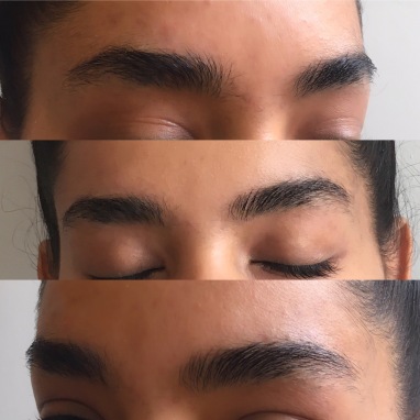 Two weeks later with RapidBrow daily use